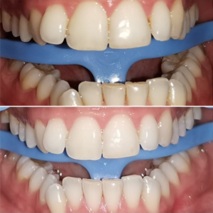 Studio Dentistico Roma prima e dopo sbiancamento denti