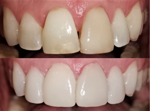 Sbiancamento denti professionale prima e dopo