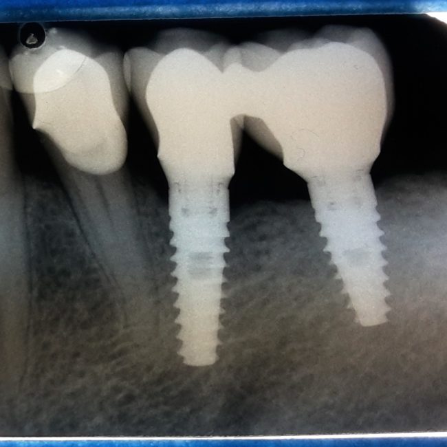 Radiografia impianti denti molari Roma